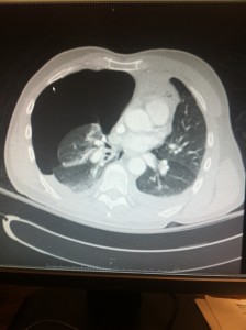 Chest CT Pneumo