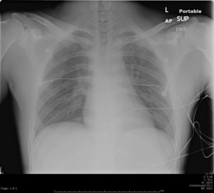 Supine UofL portable Xray