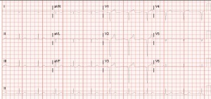 1410 EKG