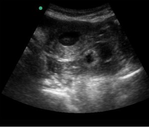 transverse view, abdominal probe