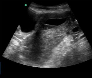 longitudinal view, abdominal probe