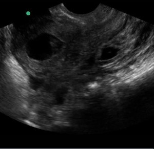 longitudinal view, transvaginal probe