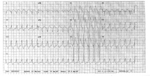 EKG 1