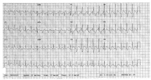 EKG 2