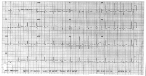 EKG 6