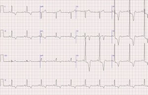 HypertrophiccardiomyopathyapicalvariantYamaguchisSyndrome