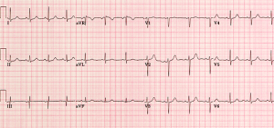 Normal_ECG