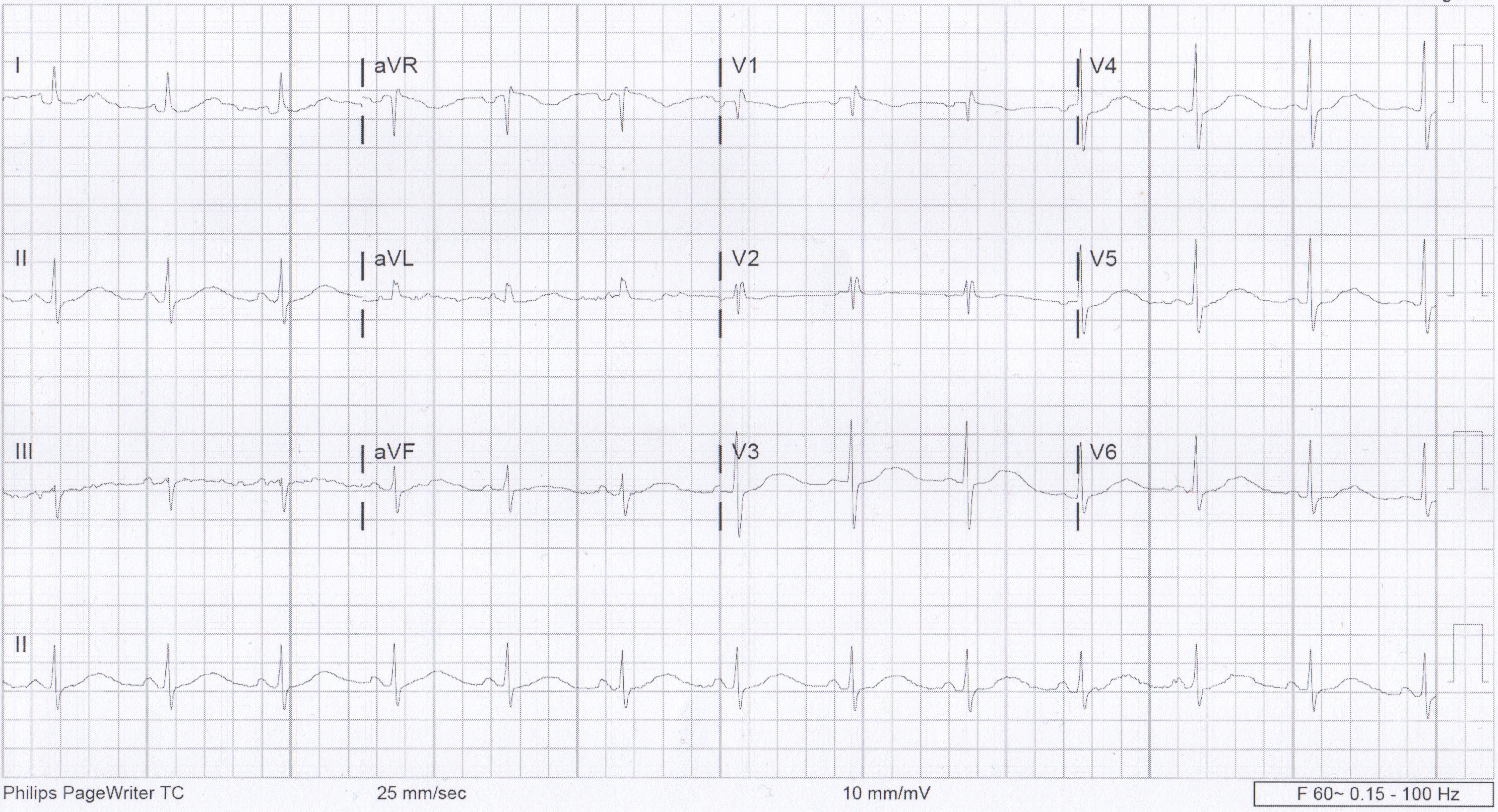 Prolonged QT EKG