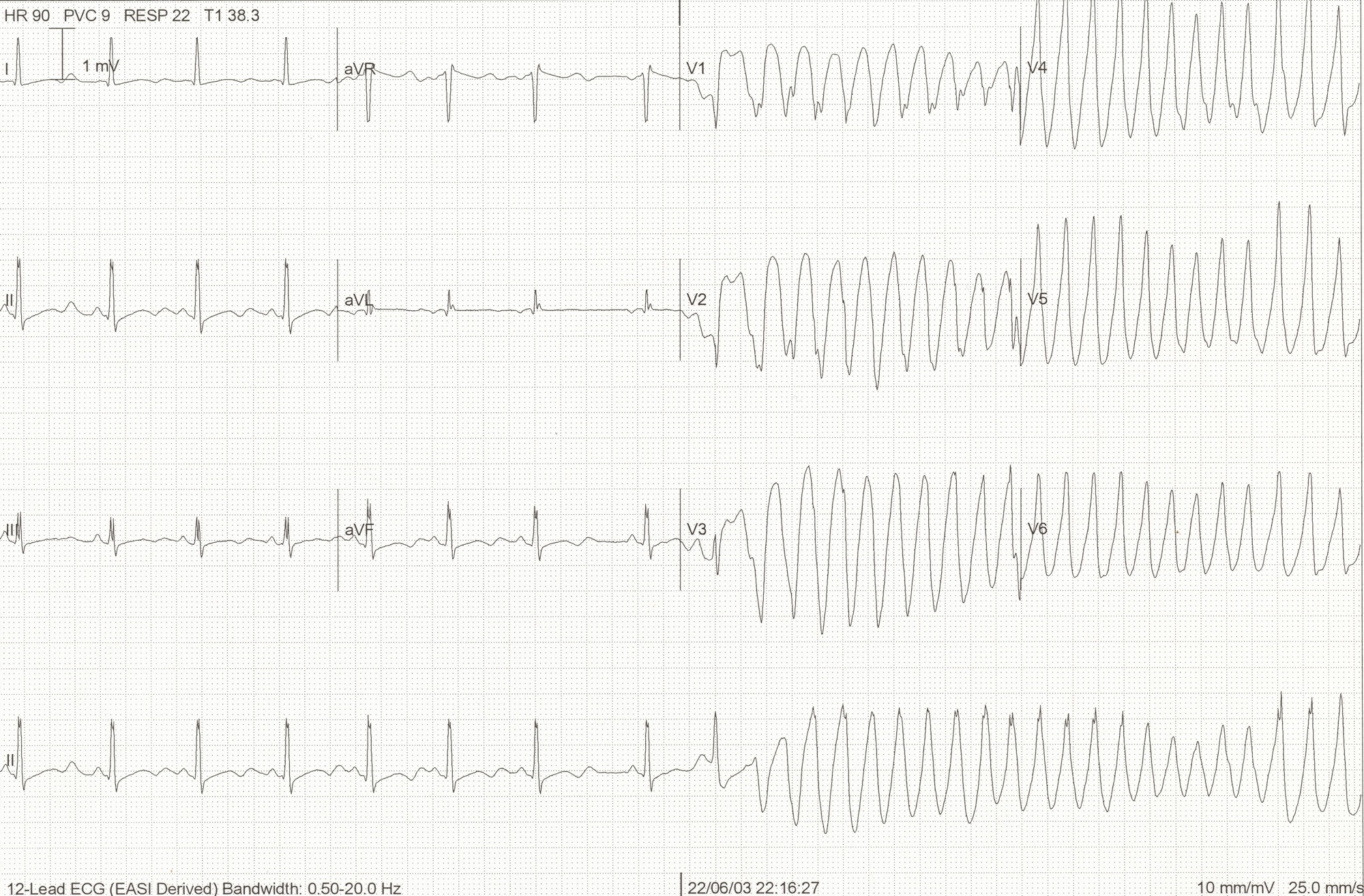 ecg_hypokalaemia_torsades