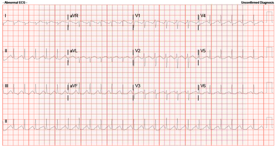 ecg_case_micu